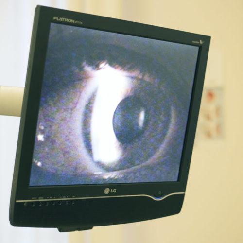 Correzione vizi di refrazione